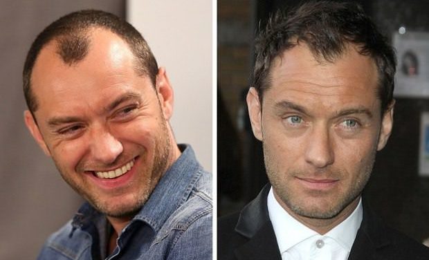 Who Is Suitable For Hair Transplant Surgery?