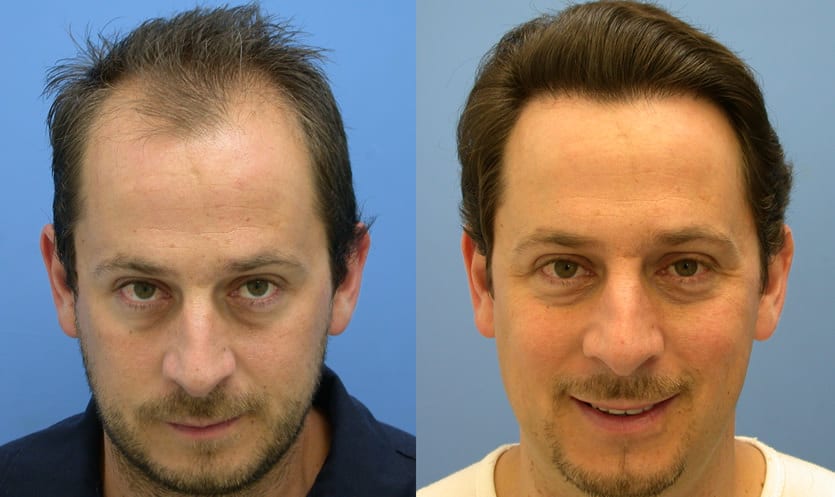 Hair Transplantation – The Trends For 2015