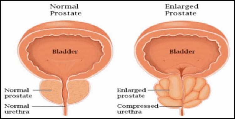 Can You Take Viagra If You Have An Enlarged Prostate?