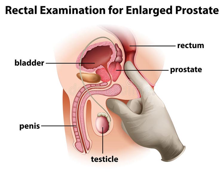 Can You Take Viagra If You Have An Enlarged Prostate?