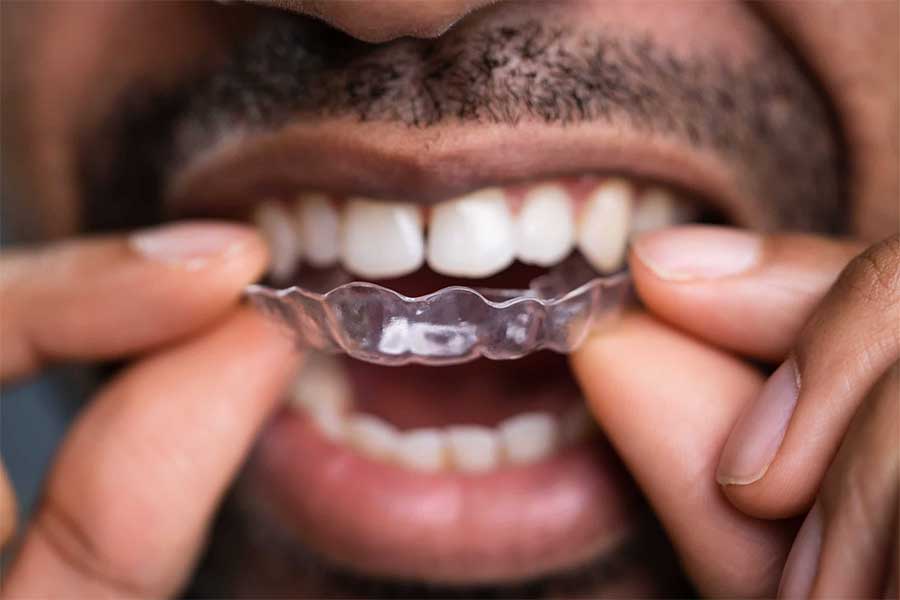 teeth aligners for men