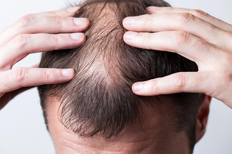 4 Common Hair Problems In Men And How To Treat Them