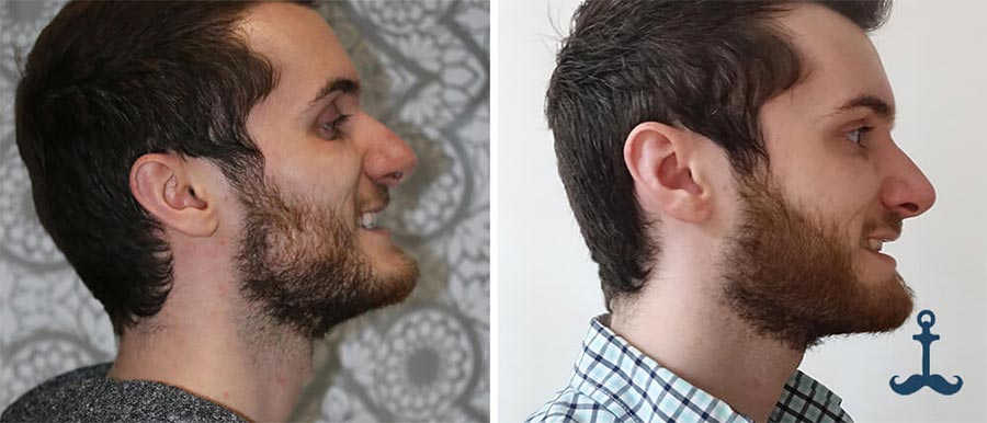 beard growth example