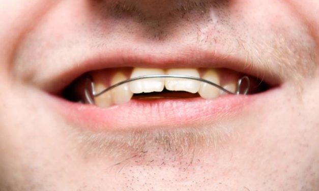 Overbite VS Underbite: What’s The Difference?